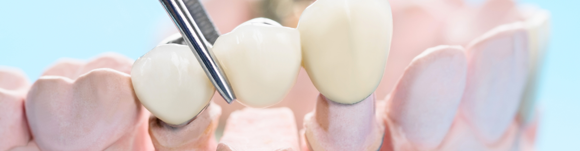 Tweezers removing dental bridge from plaster jaw model.